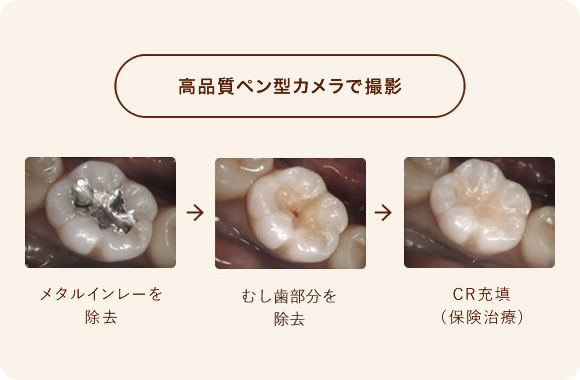 到高品質ペン型カメラで撮影 メタルインレーを
                  除去→むし歯部分を除去→CR充填(保険治療)